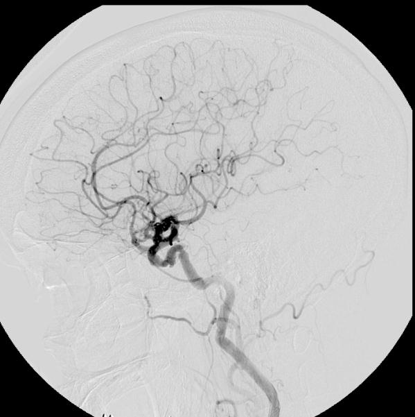 頭部血管造影：岡山大学脳神経外科のHPから